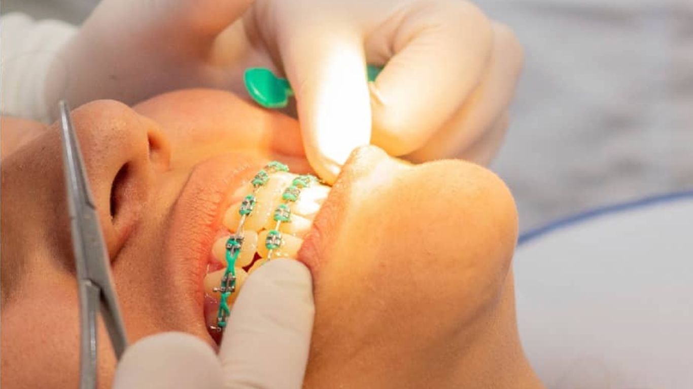 Brackets: más que sonrisas alineadas, salud y función dental